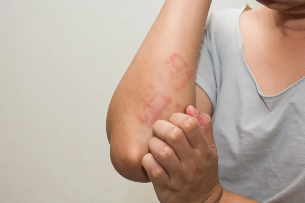 Skin rash and irritation caused by exposure to toxic mold spores in a Charlotte home.